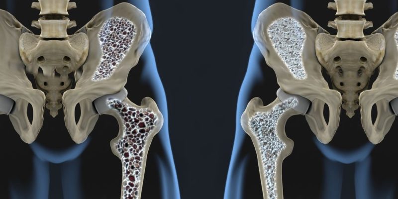 Densidad - osteoporosis